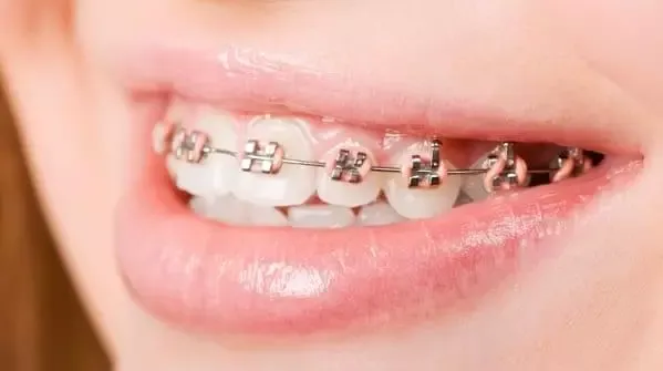 Zdjęcie Czy aparat na zęby powiększa usta? Odkryj prawdę o ich wyglądzie