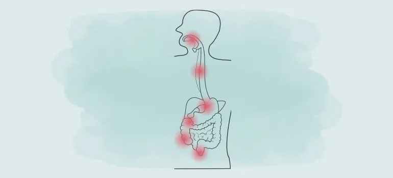 Zdjęcie Morbus Crohn Symptome: Erkennen Sie die alarmierenden Anzeichen