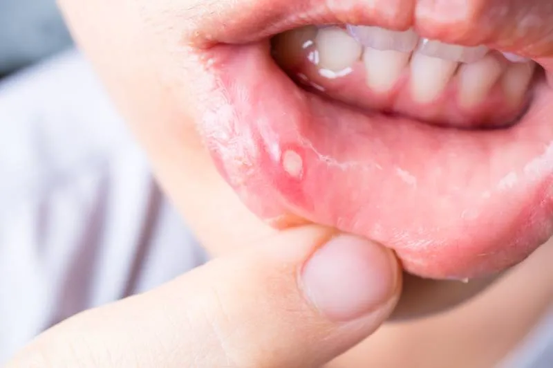 Zdjęcie Grzybica dziąseł objawy - poznaj niebezpieczne symptomy i ich skutki