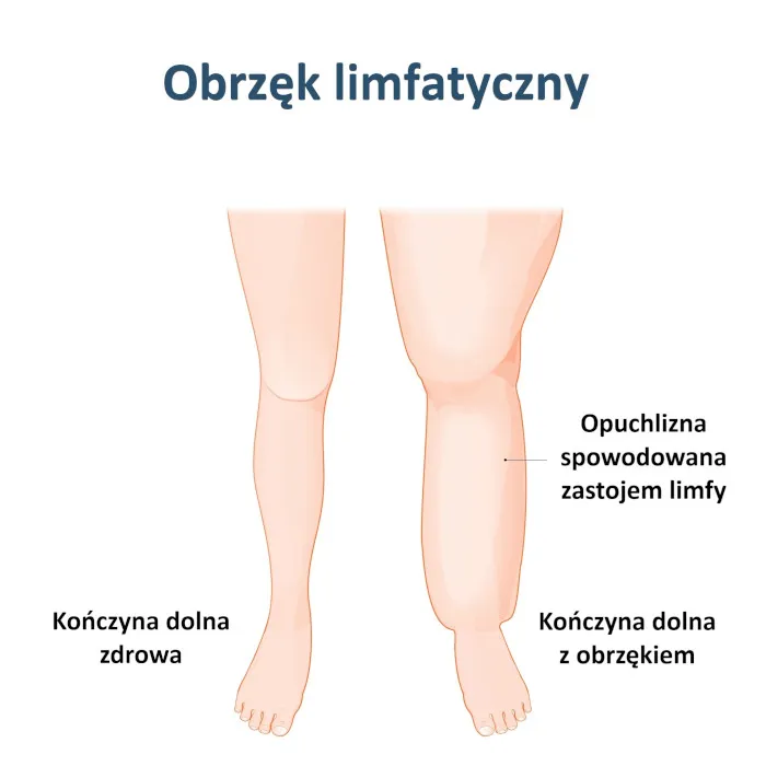 Zdjęcie Jak wygląda limfa z kolczyka? Co oznacza jej kolor i konsystencja?