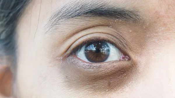 Zdjęcie Eisenmangel symptome augen: Dunkle Augenringe und ihre Ursachen erkennen