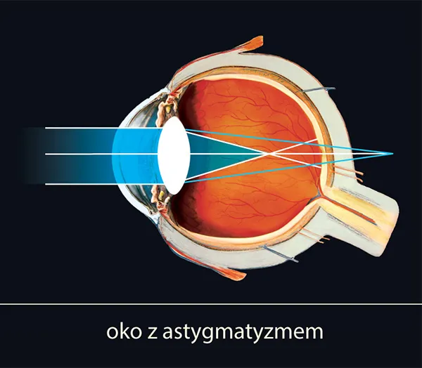 Zdjęcie Astygmatyzm: okulista czy optometrysta? Kluczowe różnice i porady