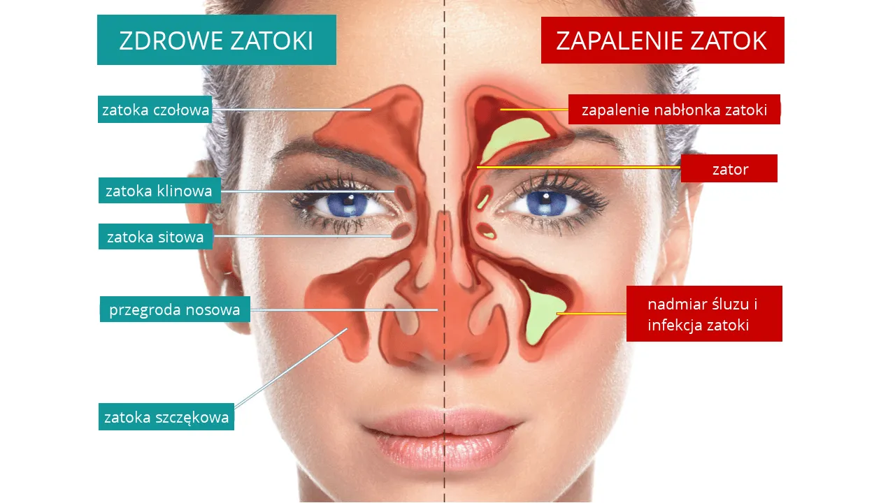 Zdjęcie Zatoka klinowa: objawy, leczenie i najważniejsze informacje medyczne