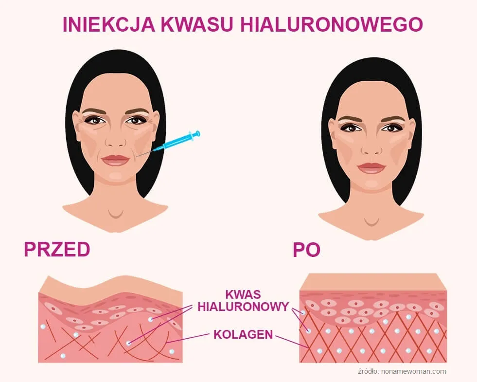Zdjęcie Kwas hialuronowy 3 czy 5 procent - jak dobrać stężenie do typu skóry?