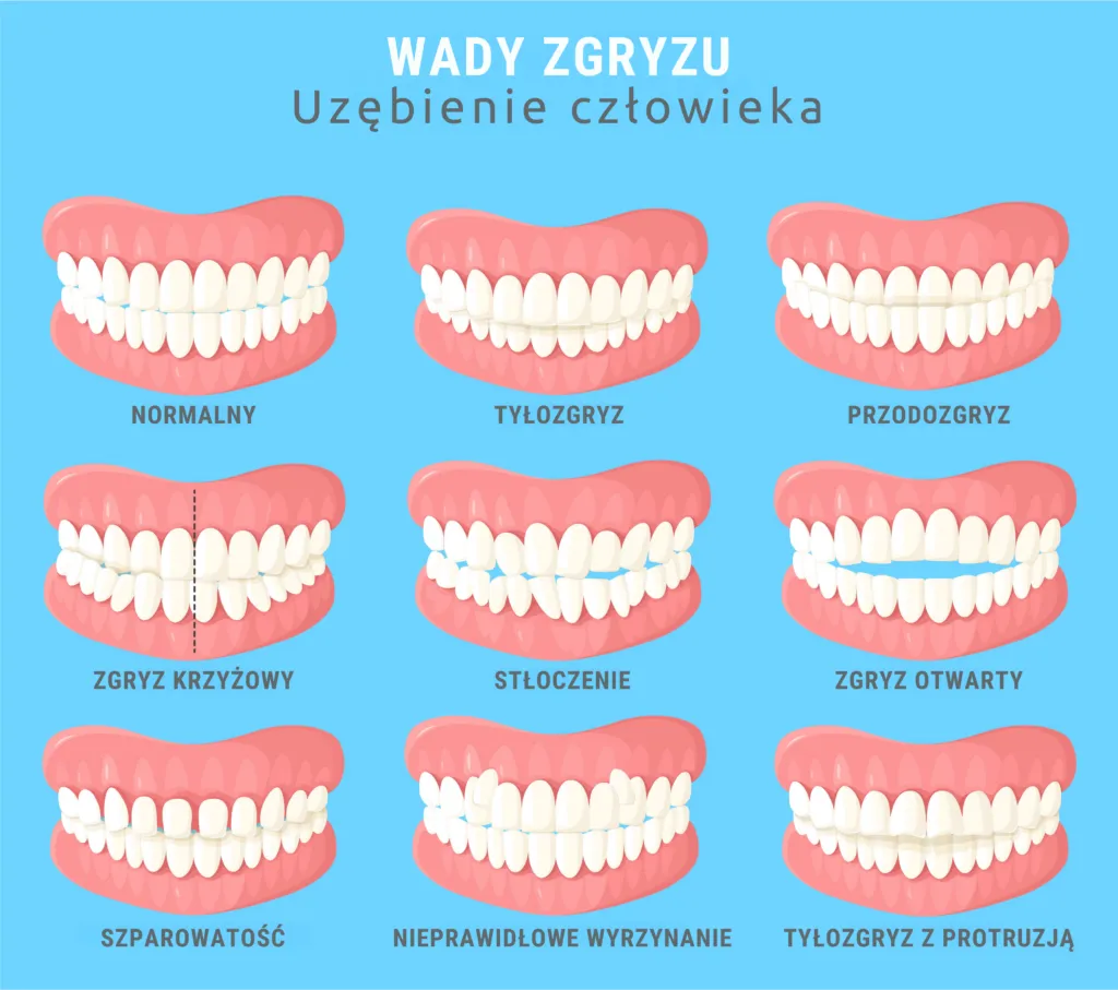 Zdjęcie Na jakie zęby zakłada się aparat? Wszystko o leczeniu wad zgryzu i rodzajach aparatów
