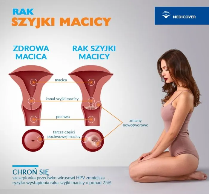 Zdjęcie Objawy raka szyjki macicy – co warto wiedzieć, by nie przegapić znaków.