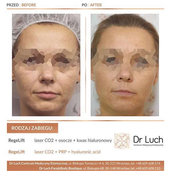 Zdjęcie Laser frakcyjny CO2 - co to jest i jak może odmłodzić skórę?