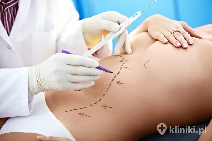 Zdjęcie Jak długo nosić ubranie uciskowe po liposukcji, aby uniknąć komplikacji?