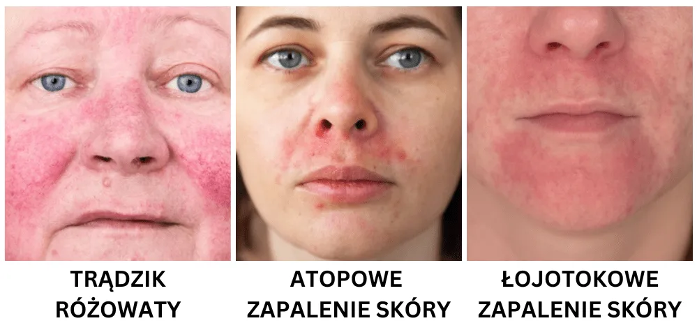 Zdjęcie Skuteczne sposoby na czerwone plamy po pryszczach i ich redukcję