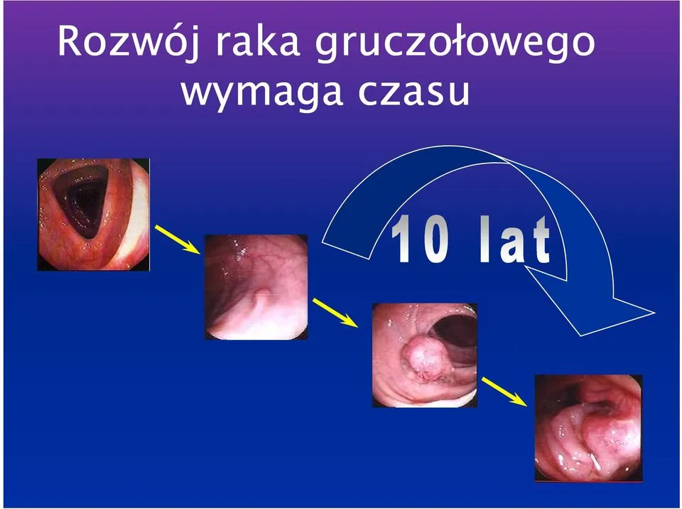 Zdjęcie Czy USG wykryje raka jelita grubego? Odkryj ograniczenia tej metody