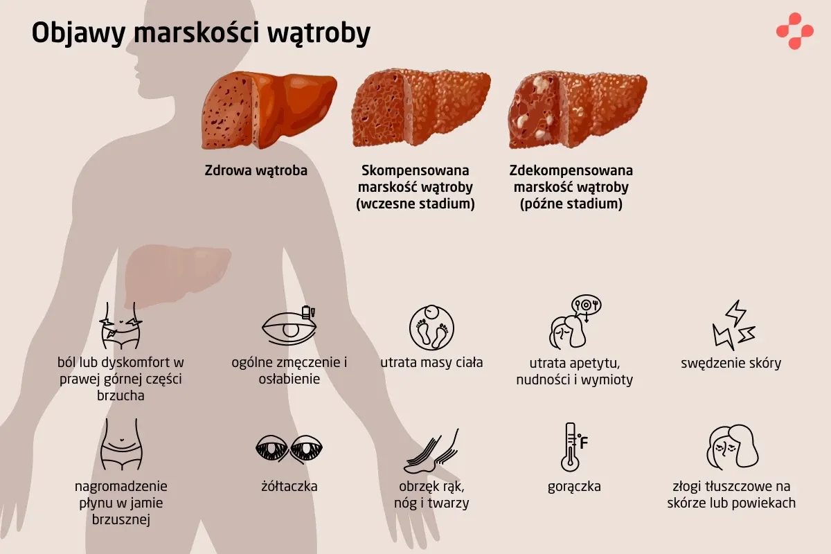 Zdjęcie Jakie są objawy bólu wątroby i co mogą oznaczać dla zdrowia