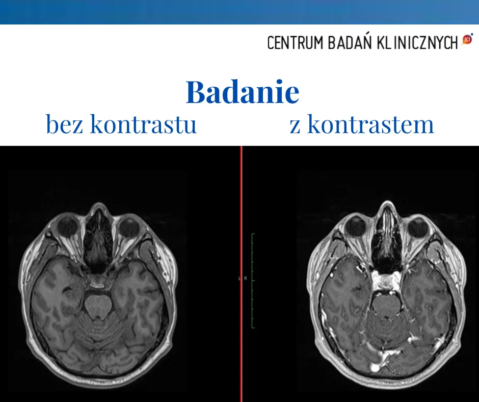 Zdjęcie Skutki uboczne biorezonansu – ból głowy, zmęczenie i inne zagrożenia