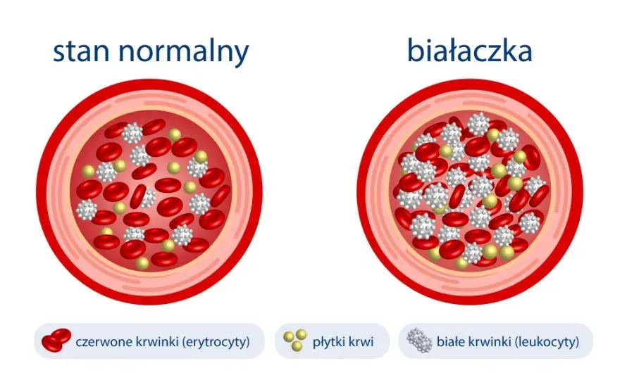 Zdjęcie Objawy białaczki u niemowlaka - jak je rozpoznać i kiedy działać