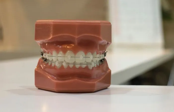 Zdjęcie Ile kosztuje założenie aparatu na zęby? Sprawdź ukryte koszty!