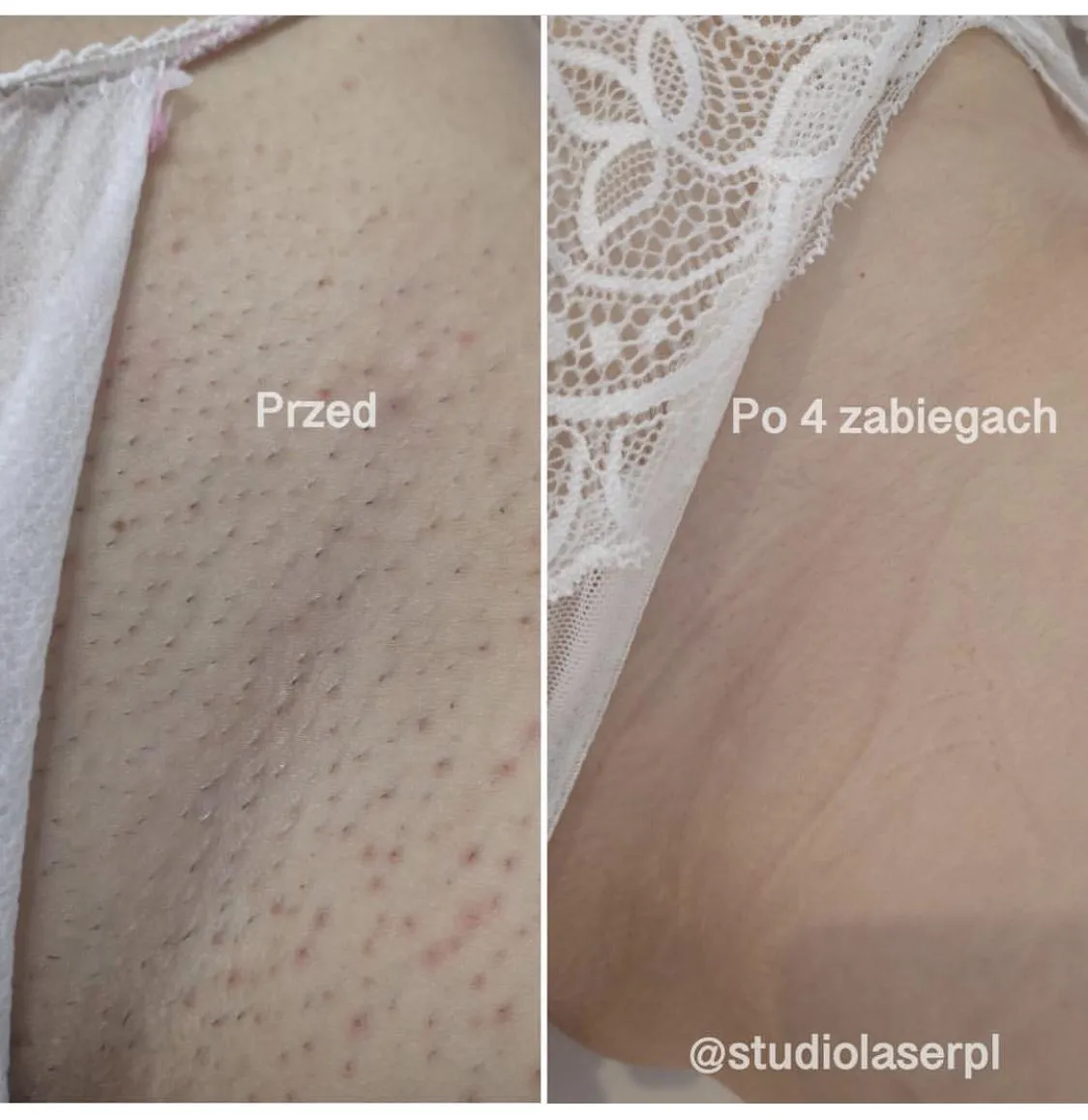Zdjęcie Depilacja laserowa na ile starcza? Efekty i opinie z forum