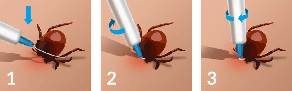 Zdjęcie Jak wyjąć kleszcza dziecku - bezpieczne metody usuwania kleszczy