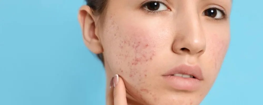 Zdjęcie Jakie kosmetyki do cery tłustej pomogą uniknąć błyszczenia i trądziku