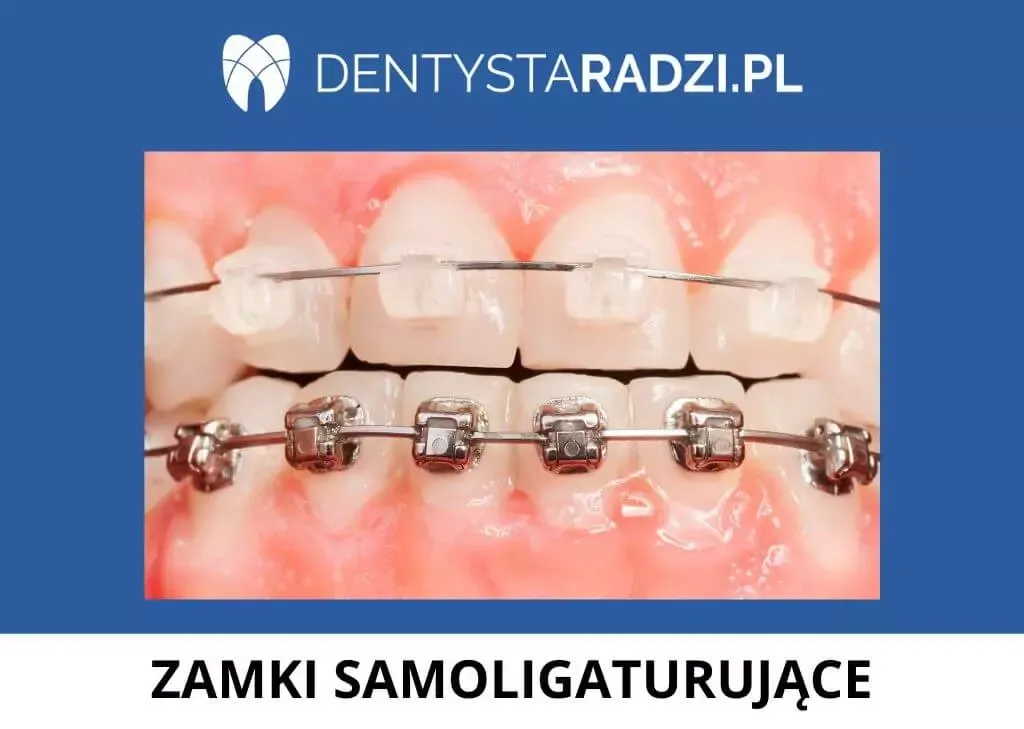 Zdjęcie Jak włożyć drut do aparatu – uniknij problemów z aparatem ortodontycznym