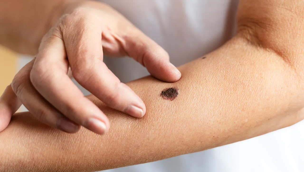 Zdjęcie Hautkrebsvorsorge: So schützen Sie sich effektiv vor Hautkrebs