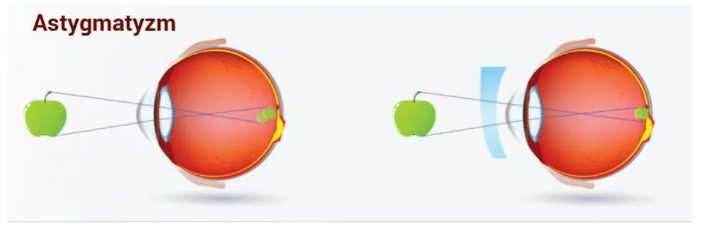 Zdjęcie Astygmatyzm a soczewki sferyczne? Poznaj prawdę i rozwiązanie