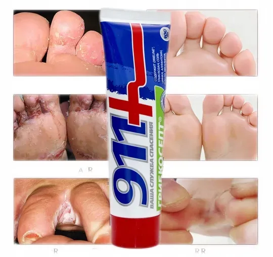 Zdjęcie Skuteczne leki na grzybicę skóry bez recepty - uniknij bólu i swędzenia