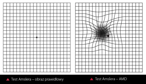 Zdjęcie Zwyrodnienie plamki żółtej: objawy, które musisz znać, zanim będzie za późno
