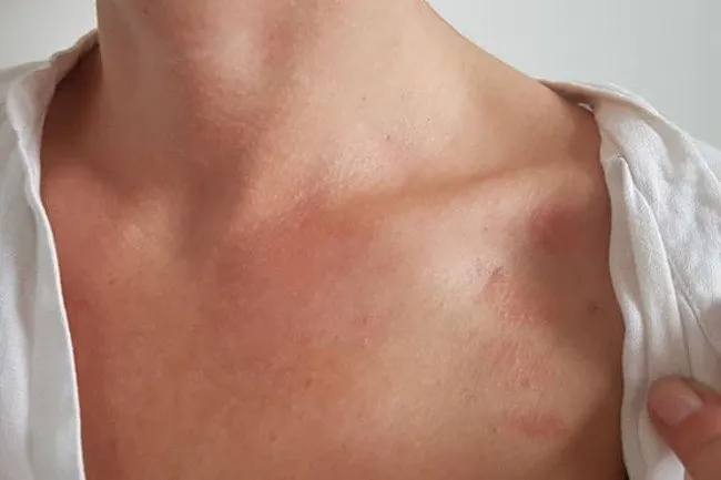 Zdjęcie Czy akryl żel uczula? Objawy alergii i bezpieczne alternatywy