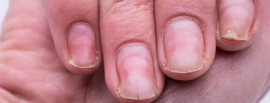 Zdjęcie Uczulenie na hybrydę: objawy, przyczyny i jak sobie radzić