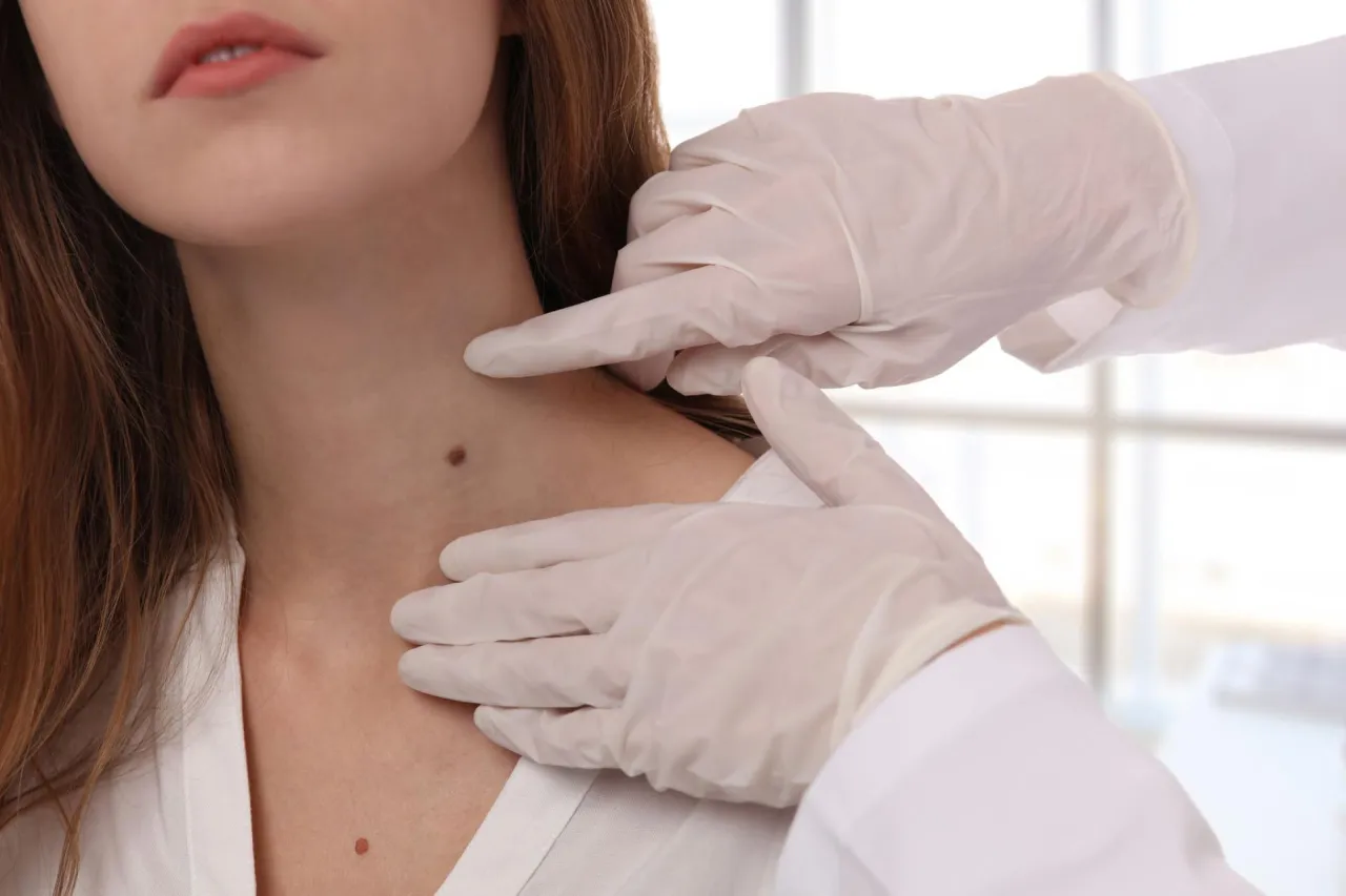 Zdjęcie Alergia na farby do włosów objawy – jak uniknąć groźnych reakcji
