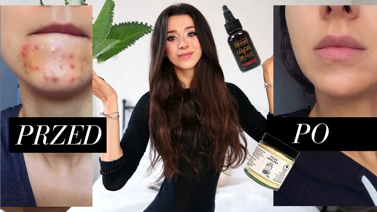 Zdjęcie Jak pozbyć się bolącego podskórnego pryszcza - skuteczne metody i porady