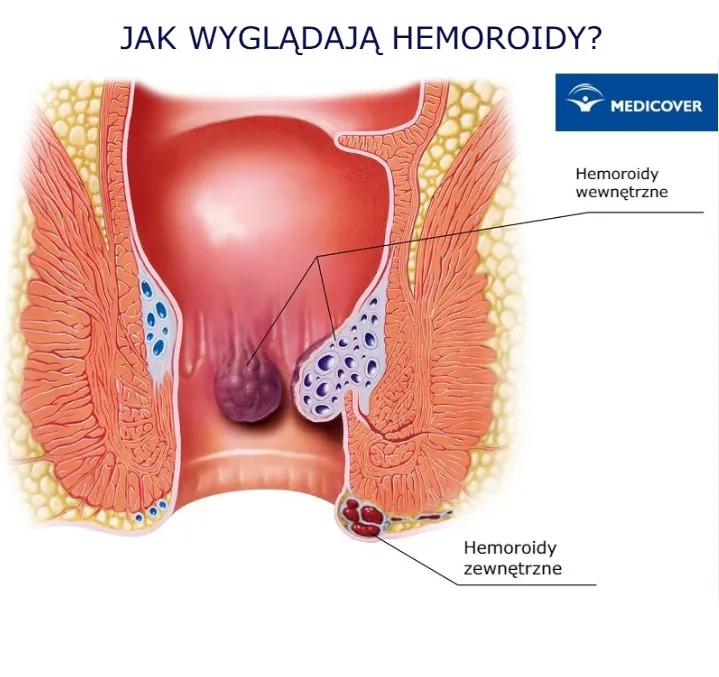 Zdjęcie Skuteczne sposoby na hemoroidy po porodzie: domowe i apteczne metody