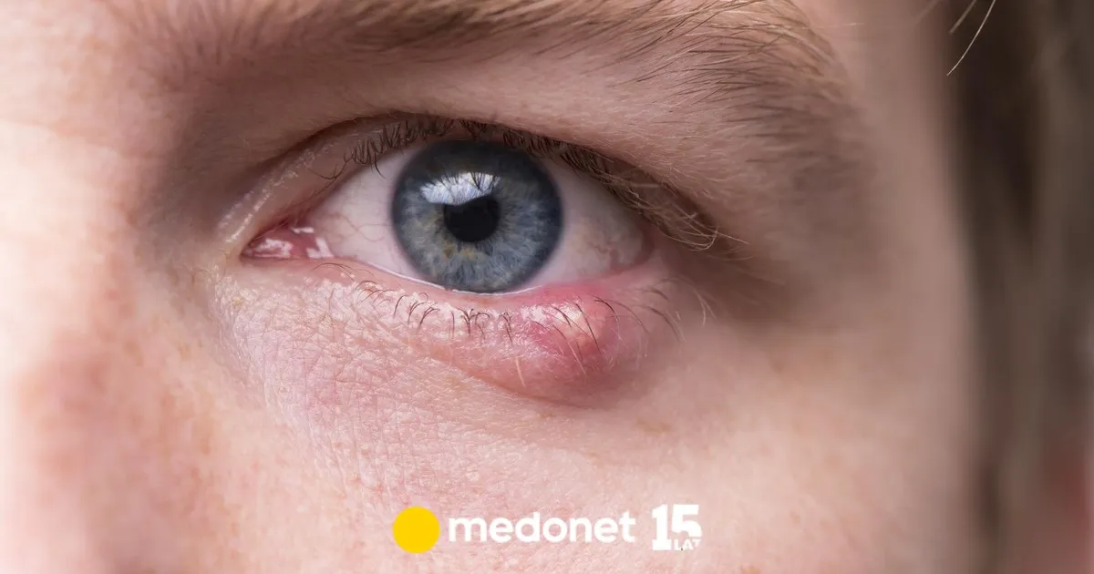 Zdjęcie Skuteczne metody na jęczmień na oku bez recepty, które działają