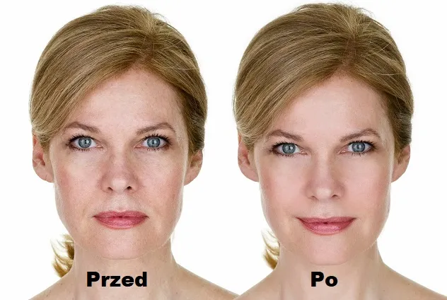 Zdjęcie Jak działa botoks? Poznaj mechanizm, efekty i bezpieczeństwo zabiegu