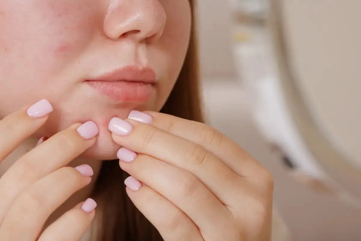 Zdjęcie Skuteczne sposoby na pryszcze: Poradnik, który działa