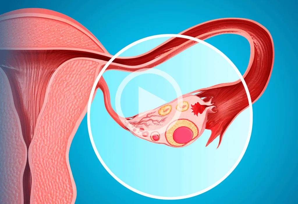 Zdjęcie Brak owulacji: dlaczego się pojawia i jak temu zaradzić