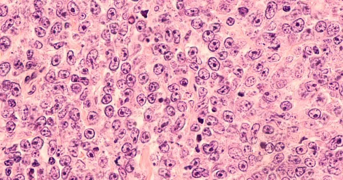 Zdjęcie Chłoniak jakie badania krwi - kluczowe testy i ich znaczenie w diagnozie