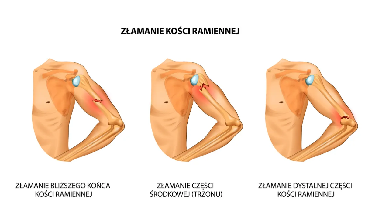 Zdjęcie Jak długo trwa rehabilitacja po złamaniu kości ramiennej? Oczekiwania i proces