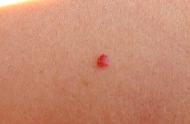 Zdjęcie Naczyniaki rubinowe jako niepokojące znamiona na skórze