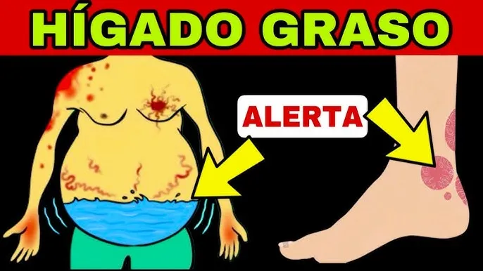 Zdjęcie Síntomas del hígado graso: ¿Estás ignorando señales alarmantes?
