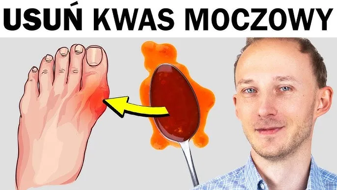 Zdjęcie Jakie są objawy dny moczanowej w stopie i jak ich unikać?