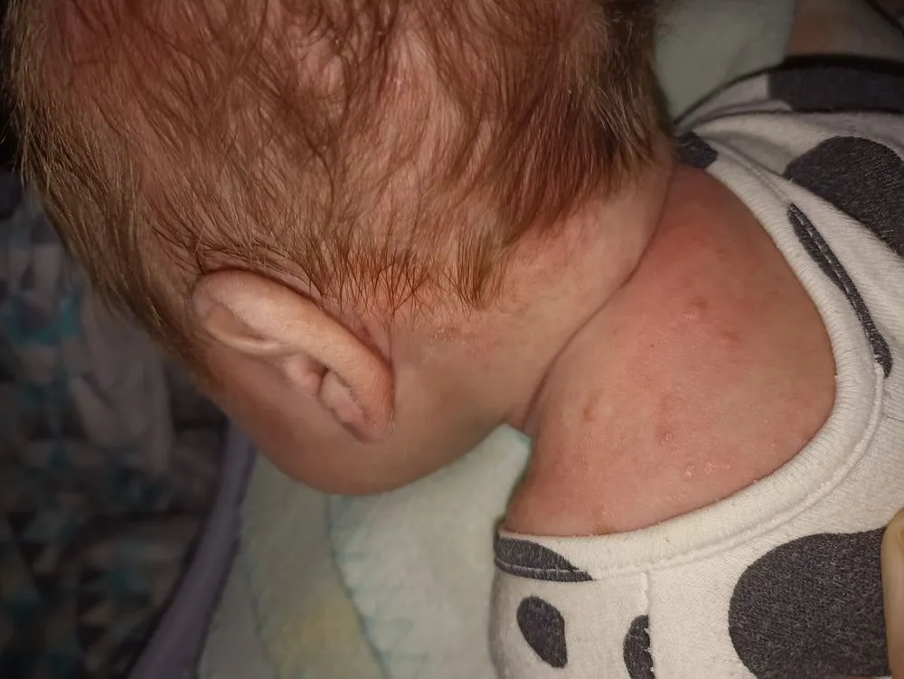 Zdjęcie Czy Bebilon Pepti uczula? Objawy alergii i co warto wiedzieć