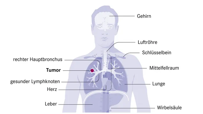 Zdjęcie Die alarmierenden Symptome des Bronchialkarzinoms erkennen und verstehen