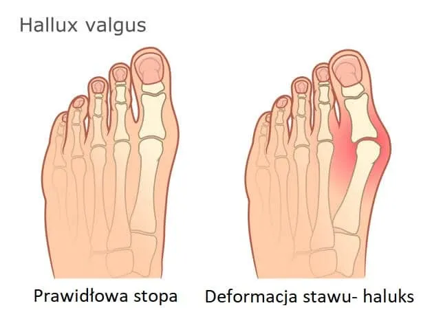 haluksy na różnych etapach zaawansowania zdjęcia