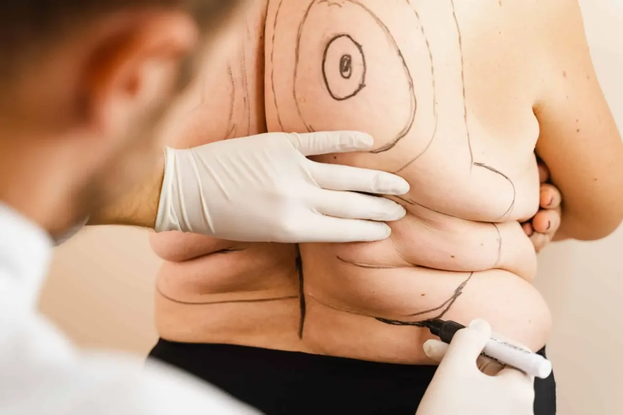 Konsultacja przed liposukcją wybór metody