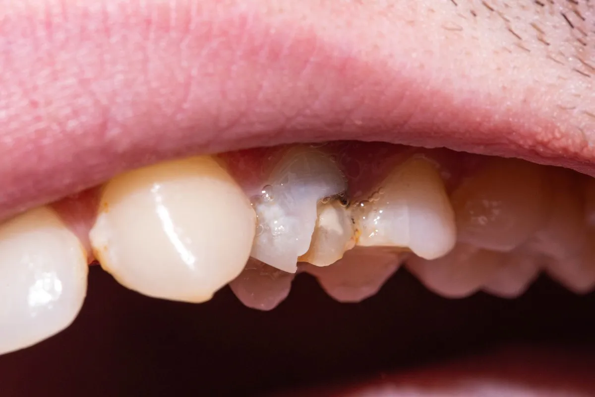 ukruszony ząb rodzaje uszkodzeń