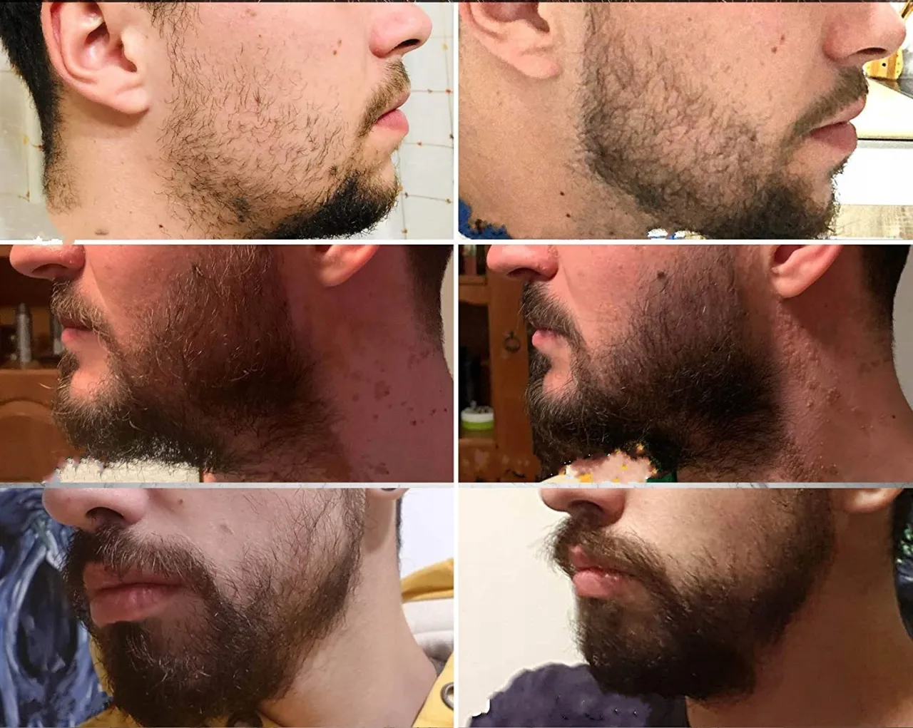 Dermaroller na zarost przed i po