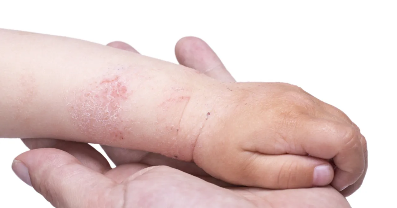 sk&oacute;ra dziecka atopowe zapalenie sk&oacute;ry