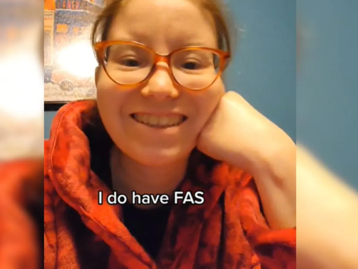 dziecko z FAS cechy twarzy