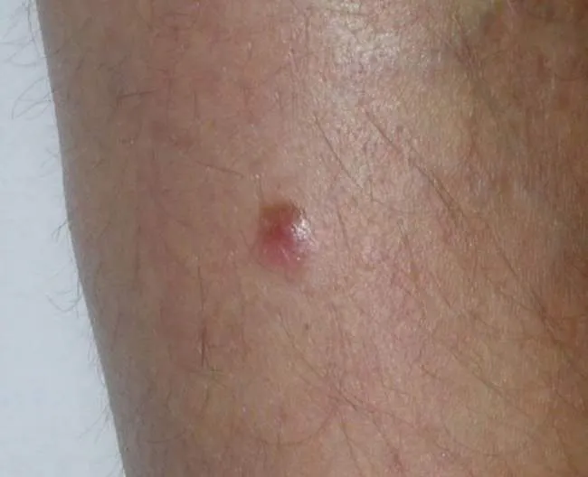 Czerniak guzkowy bezbarwnikowy akralny zdjęcia