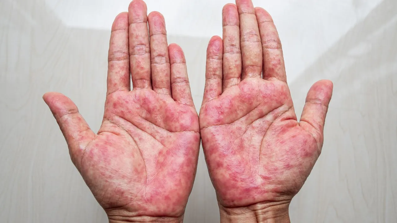czerwone dłonie od wewnątrz medycyna